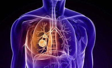 肺癌术后护理方法有哪些